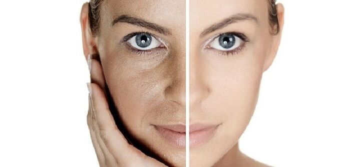 пре и после подмлађивања коже лица