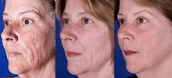 Резултат након поступка ласерског подмлађивања коже лица