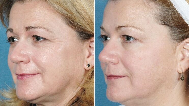 фотографије пре и после хардверског подмлађивања коже