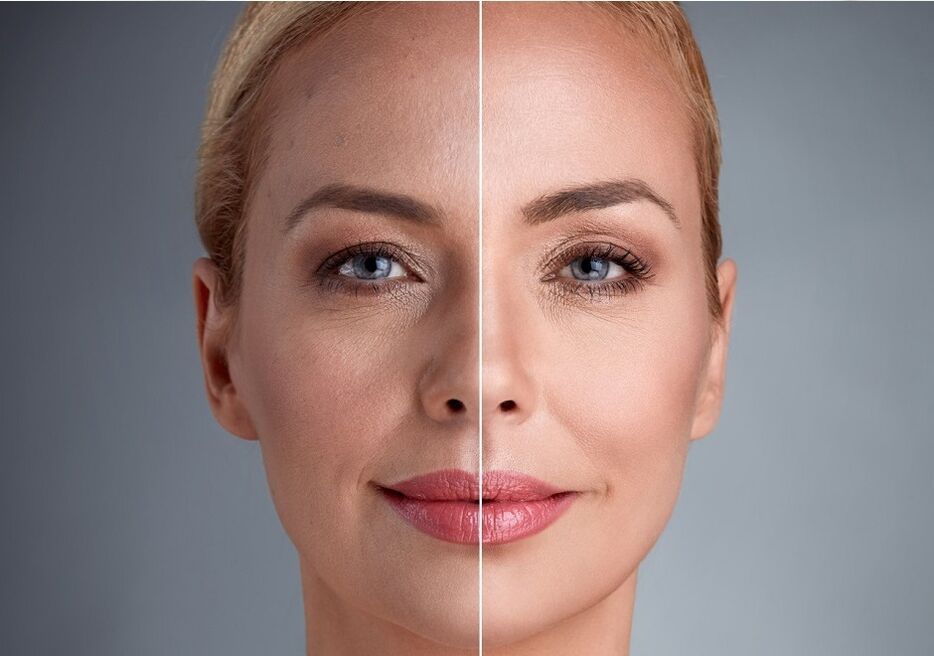 пре и после ласерског подмлађивања лица