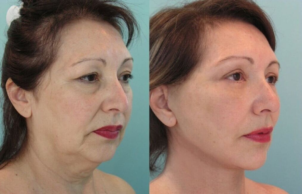фотографија пре и после подмлађивања коже